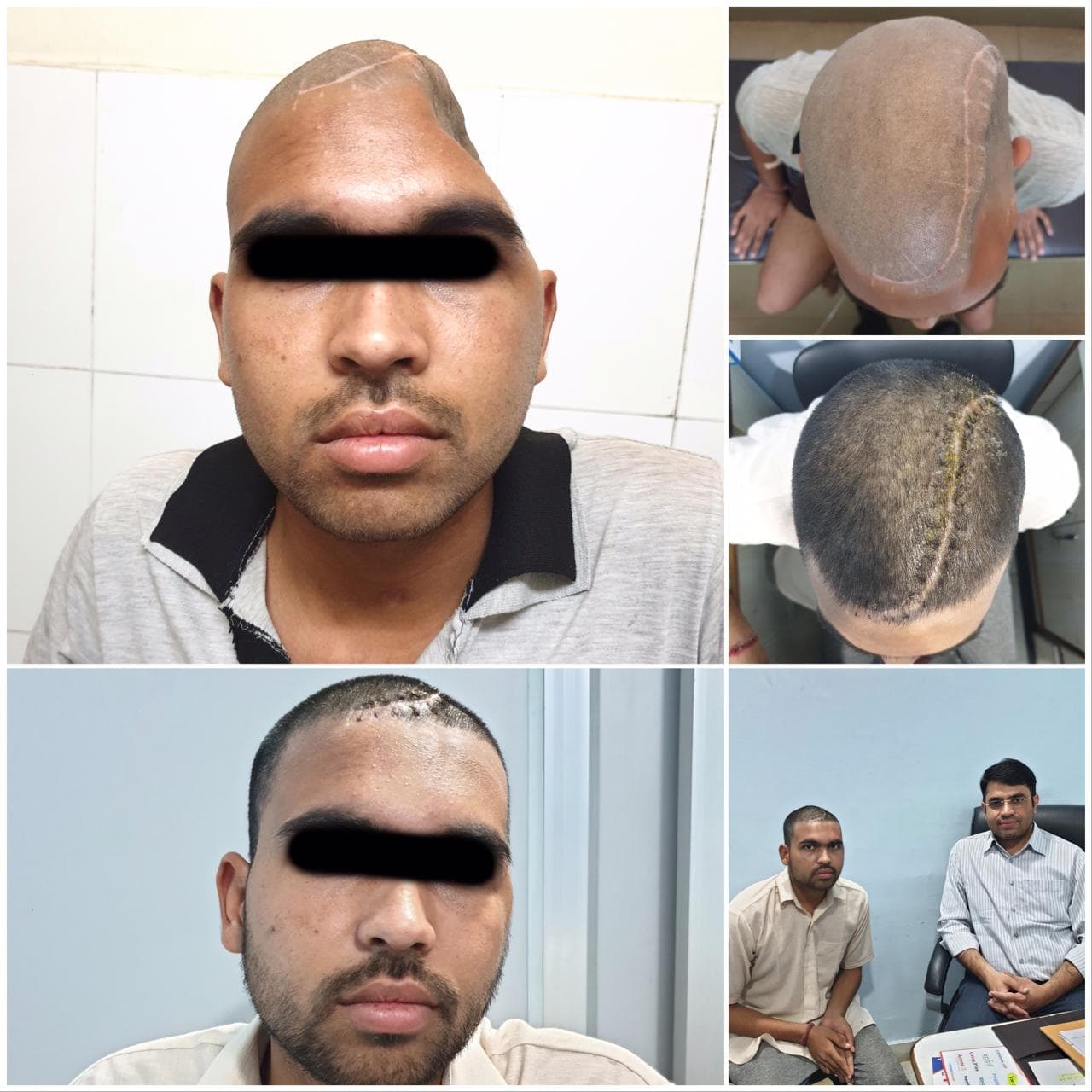 Cranioplasty (3D Printing)/ Patient-Specific Cranial Implant