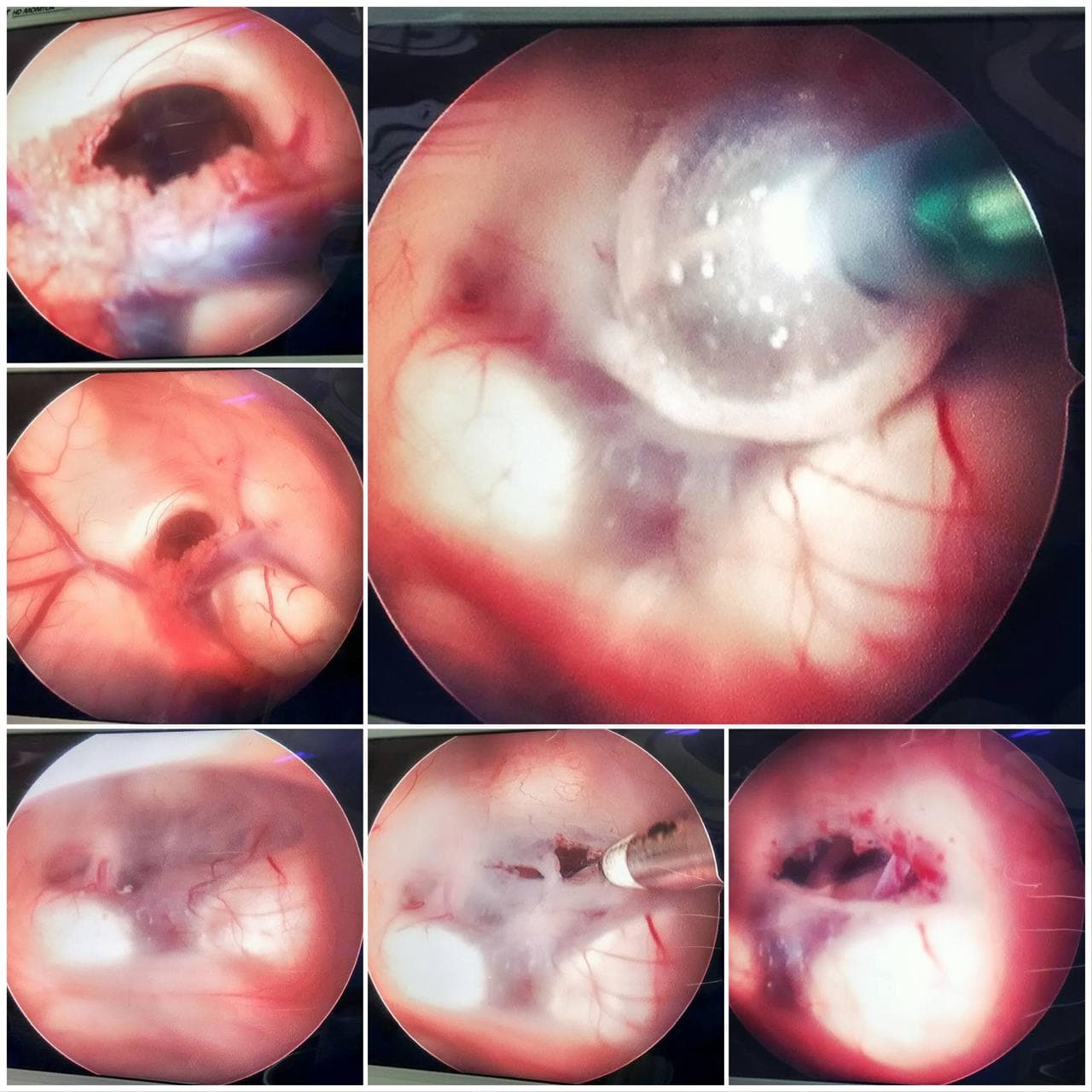 Endoscopic Brain Surgery